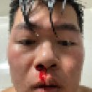 명성모이비인후과의원 | [일상] 도파민으로도 막을 수 없었던 3연속 코피🩸 후기... 올바른 지혈 방법은...?