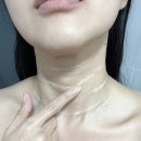더꼼꼼스킨 - 논산시 중앙로384번길 15-9 | 웨딩준비 대전유성구피부과 목주름필러 스킨부스터 시술 과정 꼼꼼후기