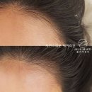 송파 문정동 장지역 가든파이브 줄리아뷰티 자연스러운 여자 M자 헤어라인