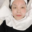 [한설에스테틱]천안불당동피부관리 슈퍼젝션 소듐히알루론산 리프팅 탄력관리 후기