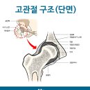 대퇴골두무혈성괴사/고관절인공관절수술/인공관절수술잘하는곳/인공관절치환술/고관절통증/고관절인공관절 이미지