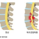 척추 협착증 증상 및 치료 시술 이미지