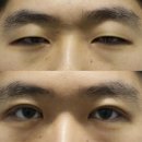 일상의 생활요리 (야간) | [부산안검하수증상] 안검하수 증상 악화 시 일상생활에 미치는 영향