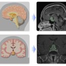 ﻿뇌하수체 종양 (Pituitary tumor) 이미지