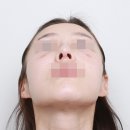 인트로성형외과의원 | 논현역 인트로성형외과 코수술(2주차까지 회복과정)