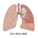 비소세포성 폐암[Non-small cell lung cancer] 종양혈액질환, 호흡기질환 이미지