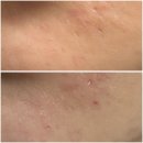 앙코르 | 흉터 치료 일지 🩹｜포텐자·쥬베룩·새살침·TCA도트필·서브시전·프락셀·앙코르/어븀조각술 후기 🎀