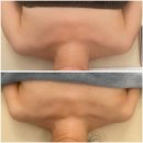 강남-103 | 강남구청역 웨딩관리 후기｜빼라리 슬리밍 센터 승모근 관리 1회만에 드레스라인 변화