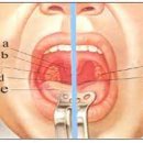 급성 인두염[acute pharyngitis] 이미지