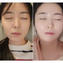 힐(heal) | 부산서면피부과 유스힐 mts 1주일 후기