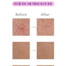 하이드로스파크 | "트러블 가리려다 인생샷 건짐!" 페리패치 스파크마이 하트 찐후기