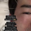안면가스 이미지