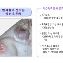 악성 흑색종 이미지