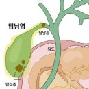 오른쪽 윗배·명치 통증 발생하는 '담낭염' 방치하다간… 이미지