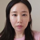 강남 울쎄라피프라임 300샷 솔직 후기(통증,붓기)