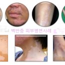 전주아름다운피부과 네이버블로그