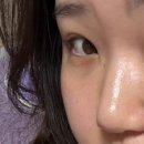 자꾸땡겨 | 광주 콧볼축소수술 한달차 후기( ́⌒ .̫ ⌒ ̀)੭