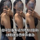 우산한방병원 | 강남 팔뚝지방분해주사 압구정 팔뚝 순삭주사 2회차 내돈내산 후기 효과 부작용