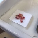 춘천 사랑니 발치 후기, 미치과에서 생각보다 안아픔