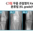 무릎시림 뻐근한 통증 관리 타이밍이 중요해요 이미지