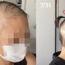 모더나 부작용은 대머리?...일본 20대 여성 백신 접종 후 심각한 '탈모' 호소 이미지