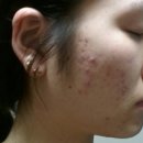 약초당한의원 | 수원여드름전문피부과 대신 한의원,7개월 다닌 내돈내산 후기