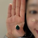 연성약국 | 손바닥 점 + 얼굴 편평사마귀 한관종 CO2 레이저 제거 후기(흑색종 의심)
