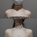 청담퍼스널의원 | [청담퍼스널의원] 어깨필러 시술 전후 후기, 용량, 부작용