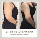 달보름 | 부산 팔뚝지흡 한달하고 보름 된 후기(서면 지방흡입 + 후관리)