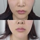 을지로 피부과 윤곽 사각턱 보톡스 효과 후기