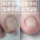 평택 송탄 고덕신도시 내성발톱 교정 전문 리온문제성발관리로 손발톱 건강 회복