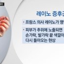 레이노 이미지