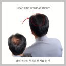 울산탈모두피문신 전후 후기 모음 고객후기 좋은 곳 &lt;헤드라인유&gt;