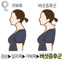 거북목보다 더 심하다는 버섯증후군 이미지