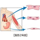 횡문근육종(Rhabdomyosarcoma) 이미지