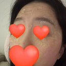 오아로피부과의원 | 청량리 비립종 제거 후기 내돈내산 (피부과 비용 통증 솔직후기)