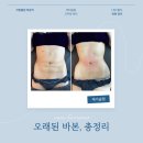 바보기계 | [지방흡입 후관리 후기]지방흡입 수술 후 오래된 바본 포기해야할까요?