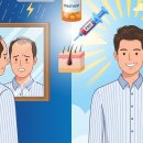 👨‍🦲 "머리 감을 때마다 한숨..." 탈모 탈출, 약물부터 모발이식까지 현실 로드맵 이미지
