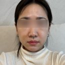 라인의원 | 인천올타이트리프팅 공식 키닥터 H의원 - 얼굴 라인 바꿔주는 리프팅 후기🔥