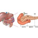 췌장암 (Pancreatic Cancer) 이미지