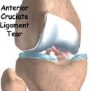 관절내시경,전방십자인대 손상-관절내시경 수술의 적응증[전방십자인대 손상] 이미지