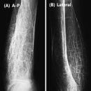 중증 베타 지중해성 빈혈의 골수 과증식(Marrow hyperplasia) 이미지