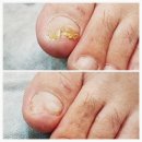 네일비타&푸스케어(건대점) | 건대무좀발톱,건대무좀관리,건대발톱무좀, 서울발톱무좀, 무좀발톱 - 네일비타&amp;푸스케어 건대점 후기!