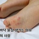 발바닥 물집 생겼을때 원인 치료 방법 이미지