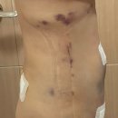 멍편한세상 | 복부지흡 골반이식 전종서 따라잡기 청라비만클리닉 내돈내산 후기 (가격, 멍, 통증, 붓기)