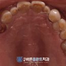 본리치과 네이버블로그