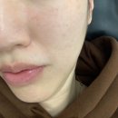 뷰티쵸이스 | 김포 구래동 피부관리 전문 초이스뷰티 콜드플라즈마+물방울리프팅 후기