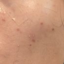 녹십자 | 창원 녹십자의원 - 점 뺀 후기, 방문시간, 소요시간 꿀팁