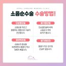 에스포피 | 이쁜이수술방법 잘하는곳 <소음순성형가격 궁금하다면 필독>