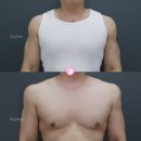 니트성형외과의원 | 전후]직각어깨 완성 용량과 실제 변화 — 옷태가 달라지는 순간 썸녀의 태도가 바뀐다 | 바이미성형외과